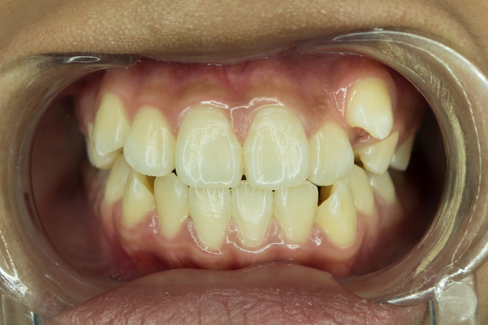 左側の八重歯