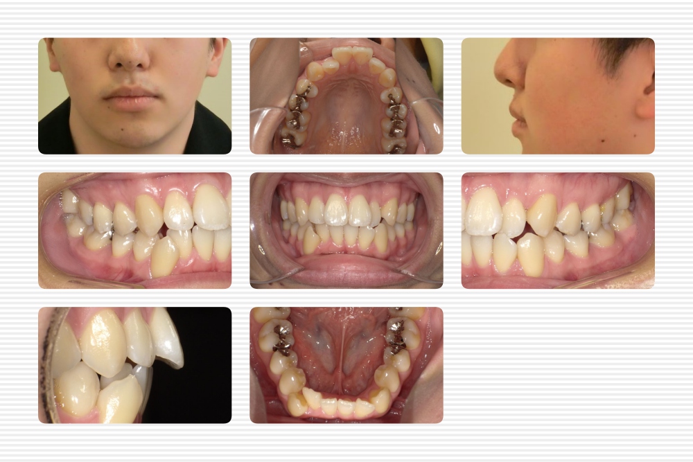 顎のずれの治し方と６つの必要な検査 横浜市星川の矯正歯科 ゆうデンタルオフィス