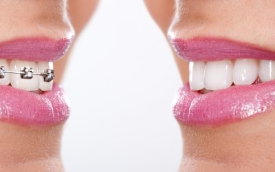 歯列矯正の治療期間