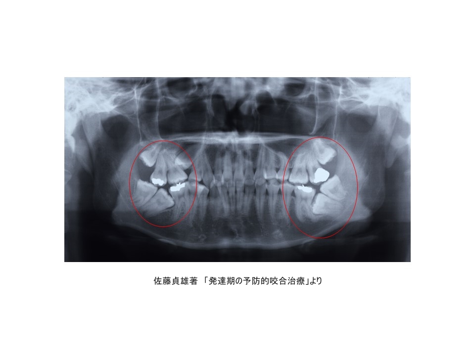 大人の歯のエックス線写真